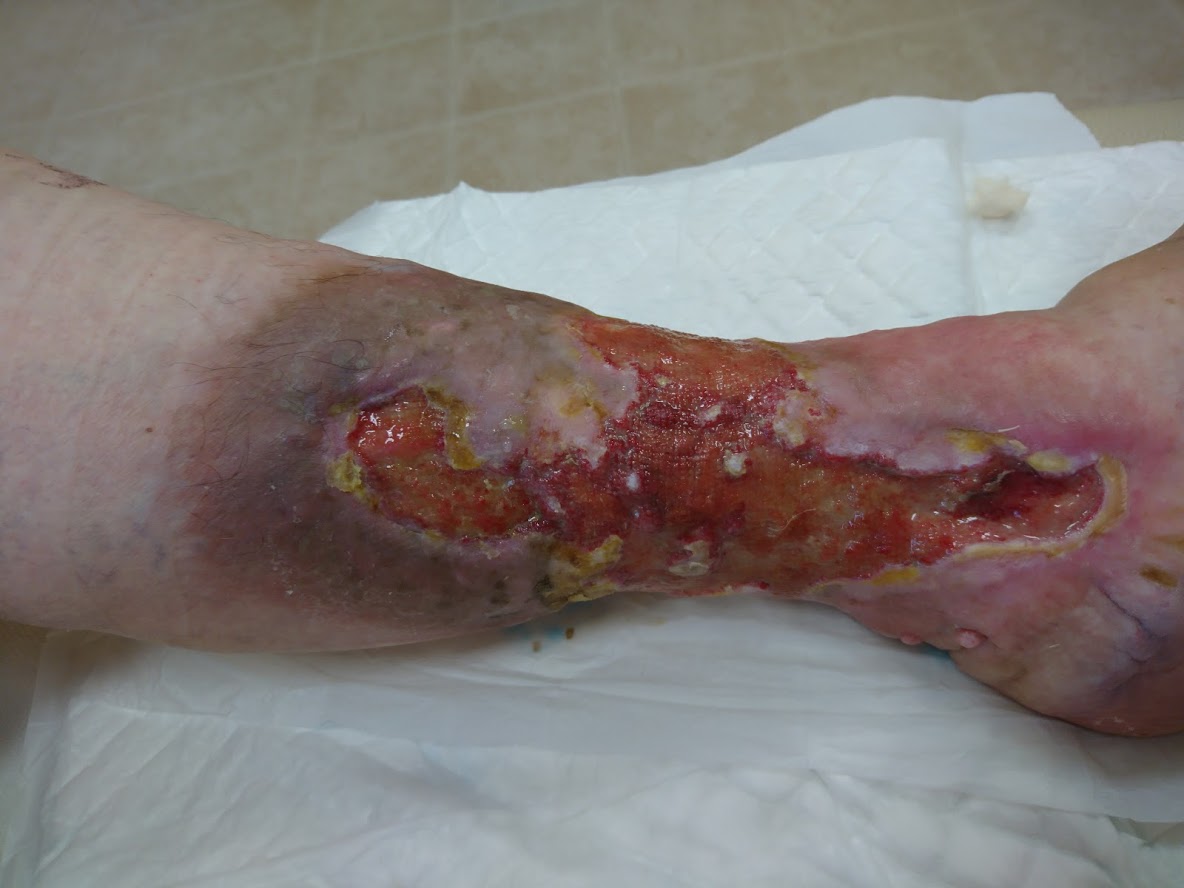 Dolgotrajna rana sega praktično od kolena pa vse do gležnja.